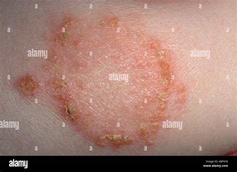 Impetigo Una Infezione Superficiale A Causa Di Staphylococcus Aureus