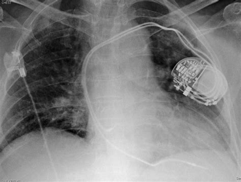 Early Complications After Pacemaker Implantations Intechopen