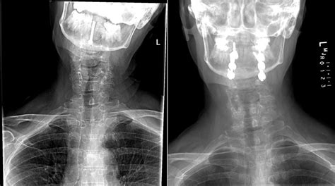 Surgeon Separates Patients Skull From Rest Of Skeleton In Radical