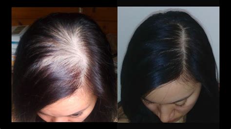 Queda de Cabelo de Mulher Propidil e Minoxidil Kirkland Calvície