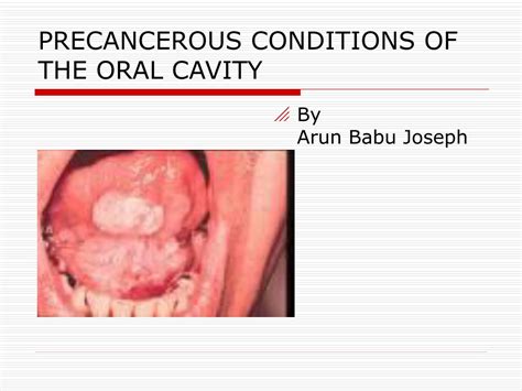 Ppt Precancerous Conditions Of The Oral Cavity Powerpoint