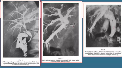 Ptc Percutaneous Transhepatic Cholangiography PPT