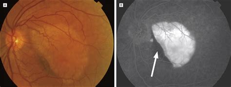 Ultra High Resolution Optical Coherence Tomography Of Retinal Pigment