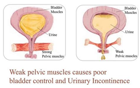 Da Vinci Clinic Stress Urinary Incontinence