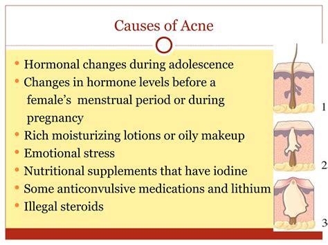 Hormonal Acne Copy Ppt