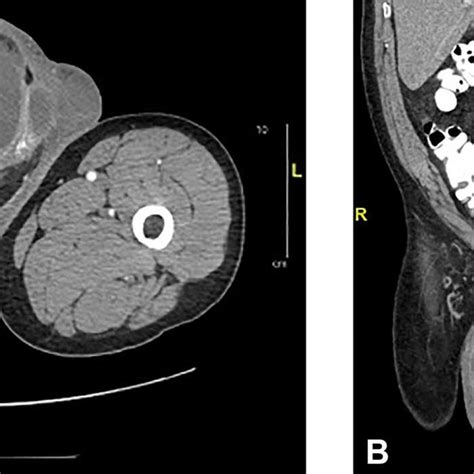 Scrotal Ultrasound Complex Septated Cystic Lesion On The Right Side Of Download Scientific