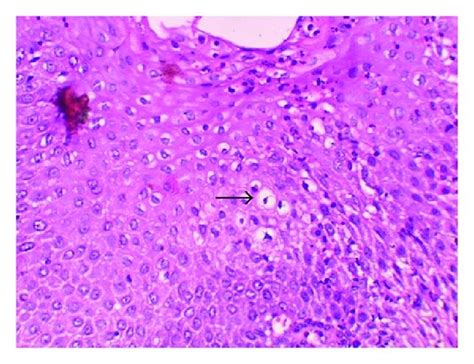 High power photomicrograph of the lesion demonstrating koilocytes... | Download Scientific Diagram