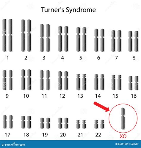 Turner Syndrome Stock Vector Illustration Of Health 26951649