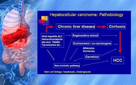 Hepatocellular Carcinoma- At a Glance