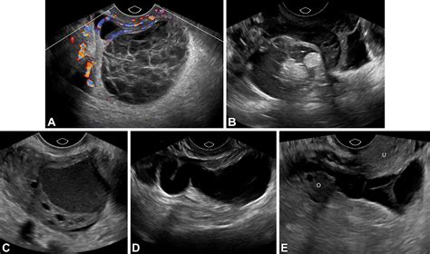 Benign Appearing Incidental Adnexal Cysts At Us Ct And Mri Putting The Acr O Rads And Sru