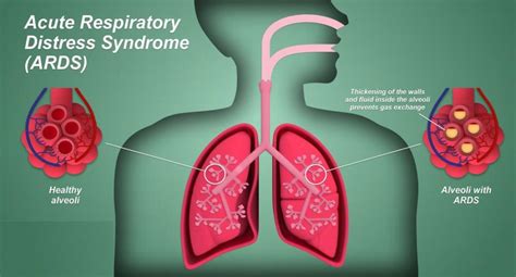 Acute Respiratory Distress Syndrome ( ARDS ) – Dr Sanjayagrawal