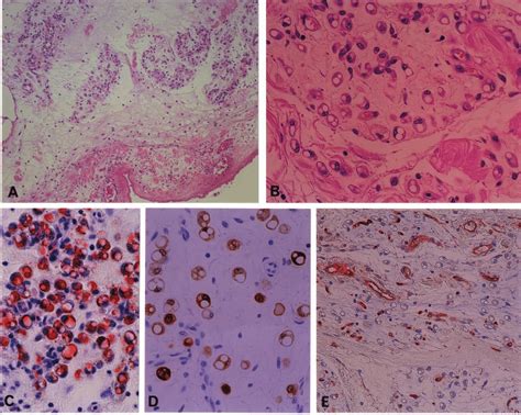 Histology And Immunohistochemistry Of The Lesion A The Thickened