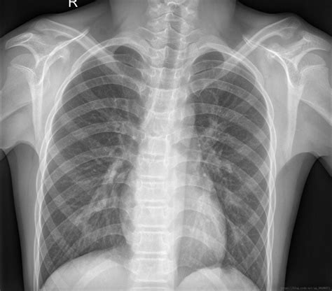 X射线肺炎图像的检测（detecting Pneumonia In X Ray Image） 使用深度学习算法对医疗图像如x Ray或ct扫描进行自动化分析期末报告 Csdn博客