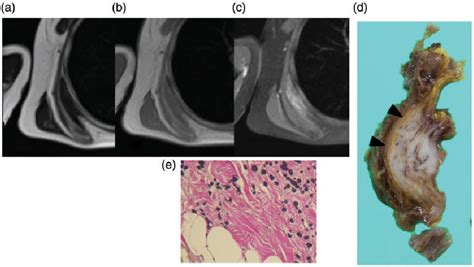 Mri Findings And Demographics Of Elastofibroma Dorsi Assessment Of