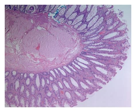 Sigmoid Colon Polypectomy Showing Benign Colonic Mucosa With