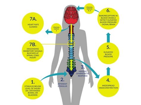 Autonomic Dysreflexia Scire Community