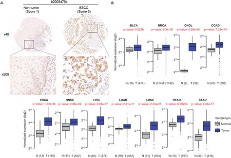 Dhx9 Is Overexpressed In Various Cancer Types A A Representative Ihc Download Scientific