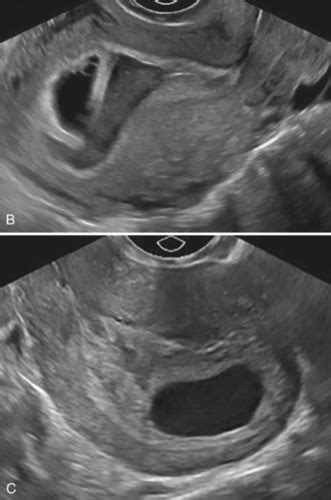 Ob Gyn Sonography Ob Overview And St Trimester Flashcards Quizlet