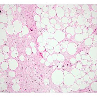 A Well Differentiated Liposarcoma WDL This Typical Example Shows