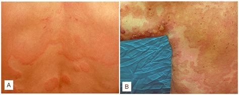 Clinical Pictures Of Chronic Urticaria And Bullous Pemphigoid Wheals