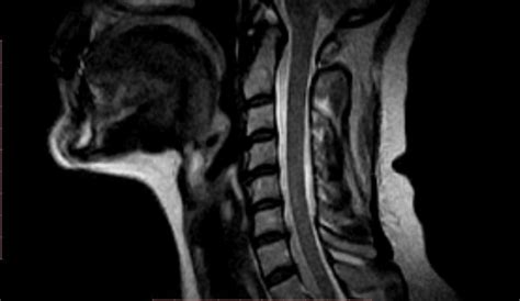 2 Hundred Cervical Disc Bulge Royalty Free Images Stock Photos