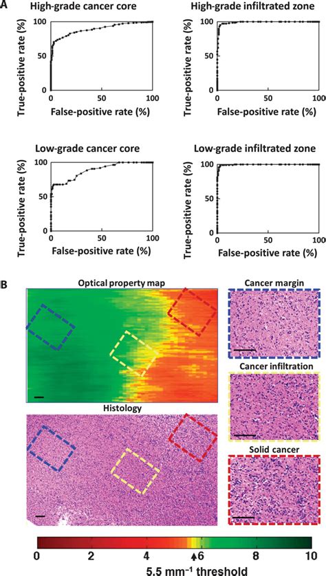 Detection Of Human Brain Cancer Infiltration Ex Vivo And In Vivo Using Quantitative Optical