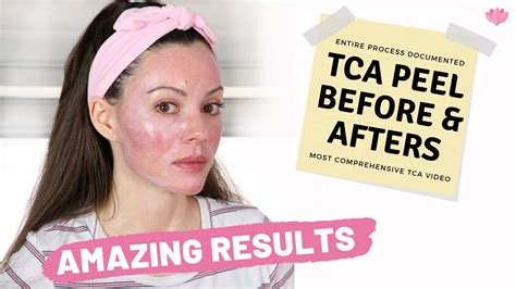 TCA Peel At Home Before Afters Day By Day Closeups Of Results