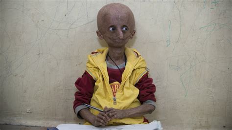 Teen With Progeria Ageing Syndrome Celebrates Milestone 15th Birthday