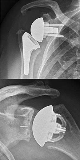 Shoulder Arthritis Kirkland And Monroe Wa Evergreenhealth