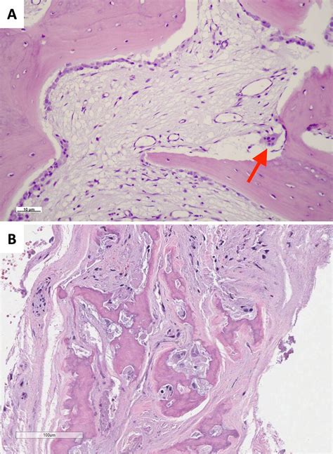 A Histological Analysis Of Newly Formed Bone Tissue Harvested From The