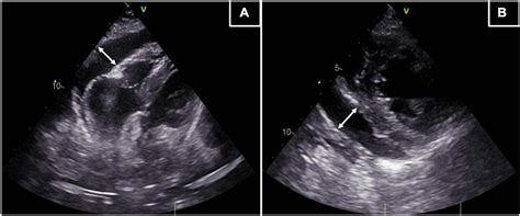 Pericardial Effusion