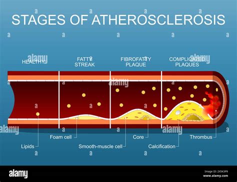 Stages Of Atherosclerosis From Lipids In Blood Flow And Fatty Streak