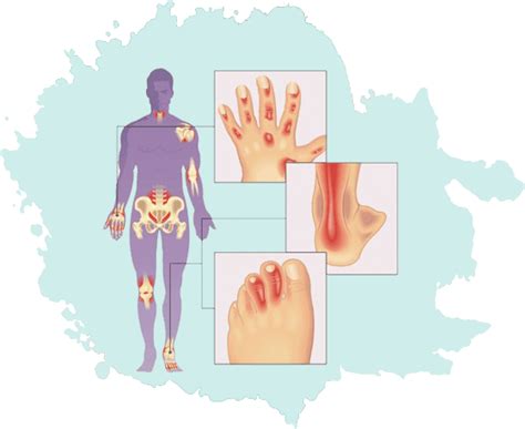 Arthritis Treatment In Jaipur By Dr Bhupendra Vaishnav Rheumatologist