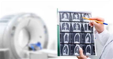 Stage 1 Lung Cancer | Symptoms, Prognosis, & Treatment