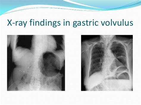 Gastric Volvulus And Other Types Of Volvulus