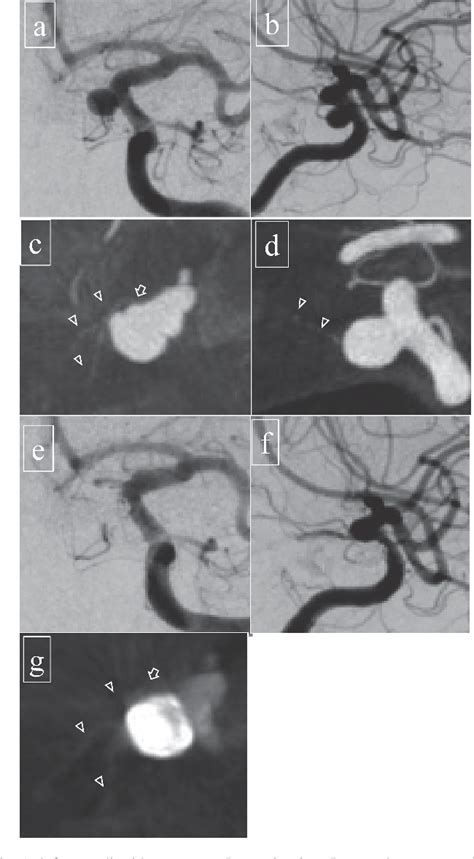 Figure 1 1 From Analysis Of Relationship Between Superior Hypophyseal