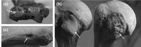 3 A Osteoarthritis Of The Distal Humeral Joint With
