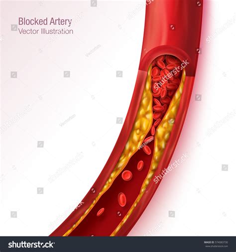 Blocked Blood Vessel Artery Cholesterol Buildup Stock Vector (Royalty Free) 574083730 | Shutterstock