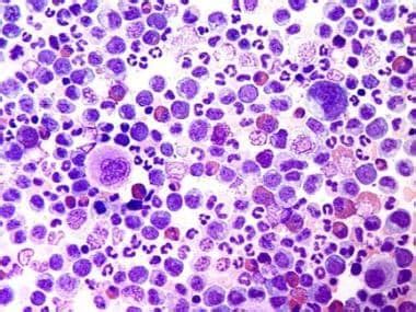 Chronic Myelogenous Leukemia Cml Workup Approach Considerations