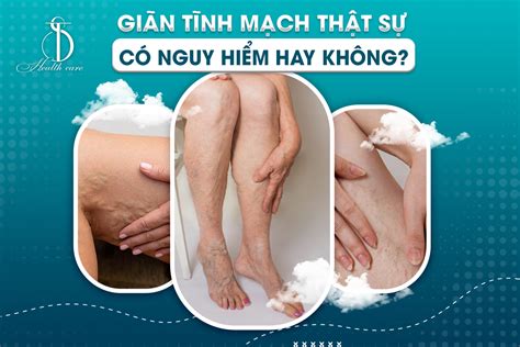 Giãn Tĩnh Mạch Có Nguy Hiểm Hay Không