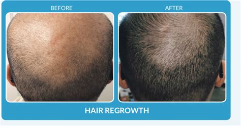 Hair Regrwoth With ProCell Before After Somalaser