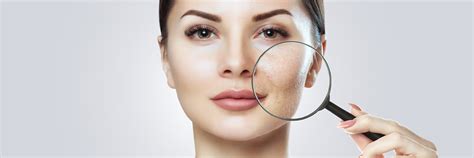 What Causes Enlarged Pores And Effective Treatment For Enlarged Pores