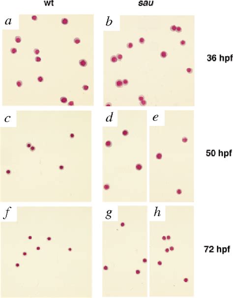 Hereditary Sideroblastic Anemia Semantic Scholar