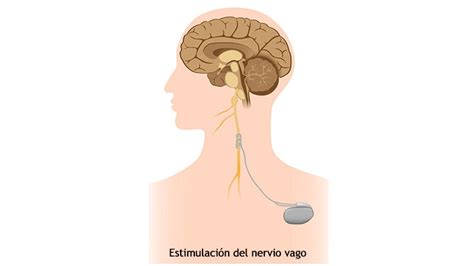 Estimulaci N Del Nervio Vago Para Tratar La Epilepsia Refractaria