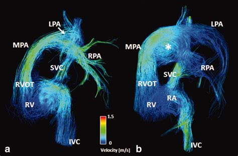 D Flow Mri Markl Journal Of Magnetic Resonance Imaging