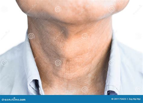 Smooth Diffuse Thyroid Swelling Of Southeast Asian Myanmar Or Burmese