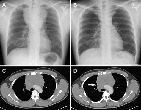 Primary Mediastinal Seminoma Presenting With Superior Vena Caval Obstruction Bmj Case Reports