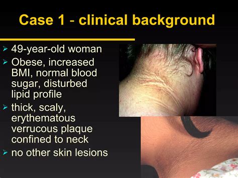Acanthosis Nigricans Ppt