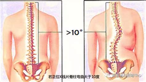 【脊柱側彎自查】1分鐘！測孩子脊柱歪不歪！家長必看！ 每日頭條