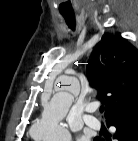 Subclavian Artery Anatomic Review And Imaging Evaluation Of Abnormalities Radiographics